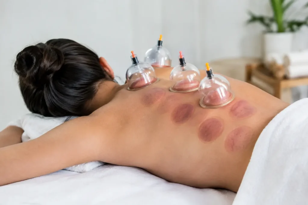 Does Cupping Leave Marks? What to Expect